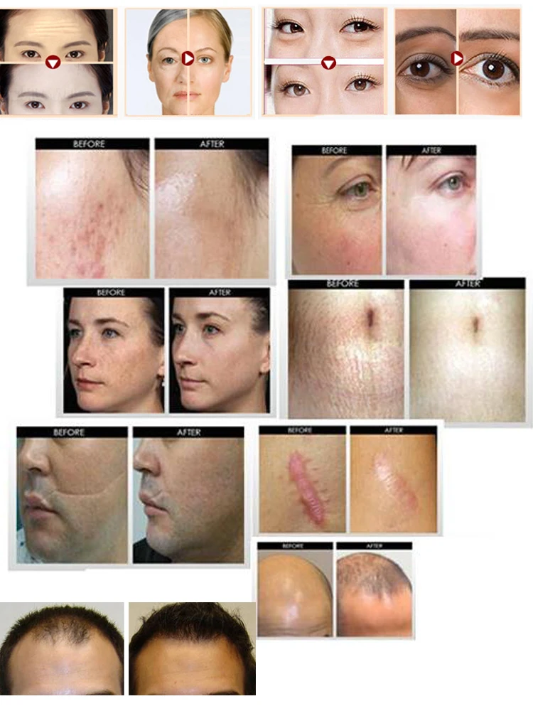 Mezoroller Derma Roller DRS 540 Needle Microneedling for Skin Care Body Treatment Meso Face Dermo Mikronadel Micro Agulha Facial Mezoroller Derma Roller DRS 540 Needle Microneedling for Skin Care Body Treatment Meso Face Dermo Mikronadel Micro Agulha Facial