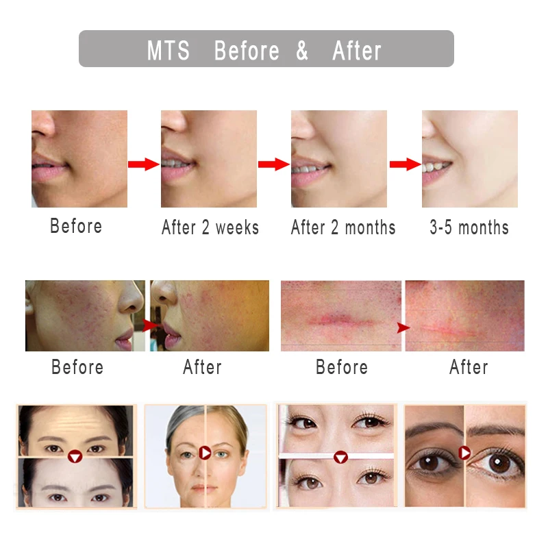 Mezoroller Derma Roller DRS 540 Needle Microneedling for Skin Care Body Treatment Meso Face Dermo Mikronadel Micro Agulha Facial Mezoroller Derma Roller DRS 540 Needle Microneedling for Skin Care Body Treatment Meso Face Dermo Mikronadel Micro Agulha Facial