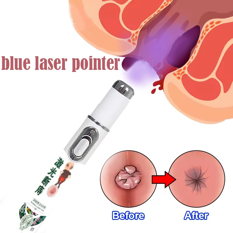 YP1117  Medical Hemorrhoid Laser PenTreat External Internal Hemorrhoids Anus Swelling Pain Relief Laser Pointer Hemorrhoid Treat