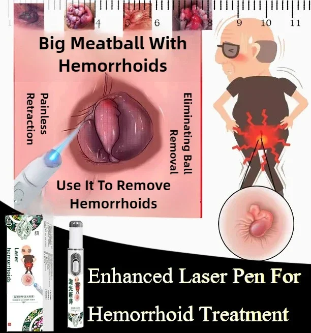 YP1117  Medical Hemorrhoid Laser PenTreat External Internal Hemorrhoids Anus Swelling Pain Relief Laser Pointer Hemorrhoid Treat