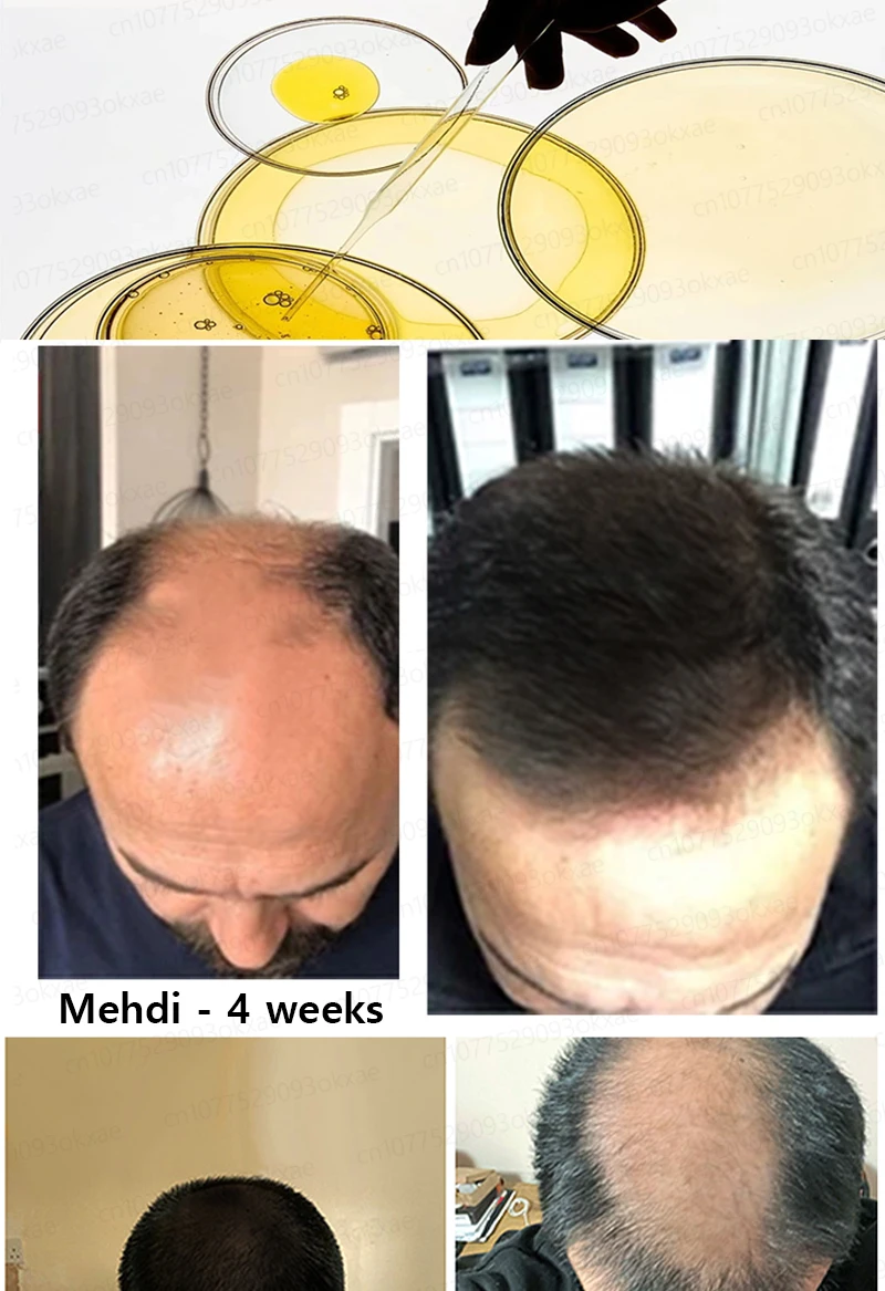 Grow cool hair secretly and surprise everyone. Say goodbye to baldness and hair loss now Grow cool hair secretly and surprise everyone. Say goodbye to baldness and hair loss now