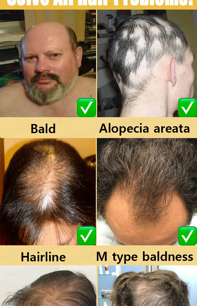 Grow cool hair secretly and surprise everyone. Say goodbye to baldness and hair loss now Grow cool hair secretly and surprise everyone. Say goodbye to baldness and hair loss now