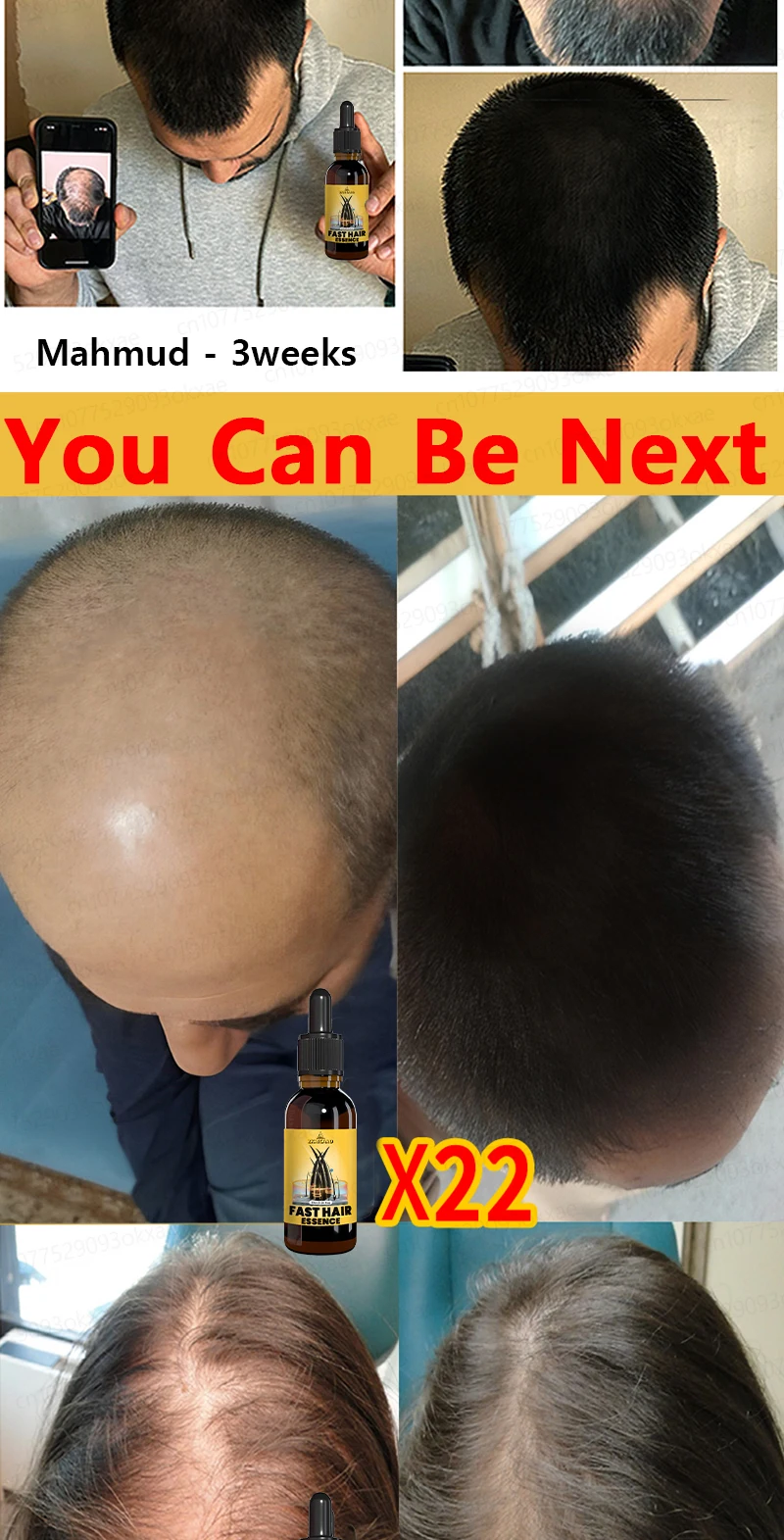 Grow cool hair secretly and surprise everyone. Say goodbye to baldness and hair loss now Grow cool hair secretly and surprise everyone. Say goodbye to baldness and hair loss now