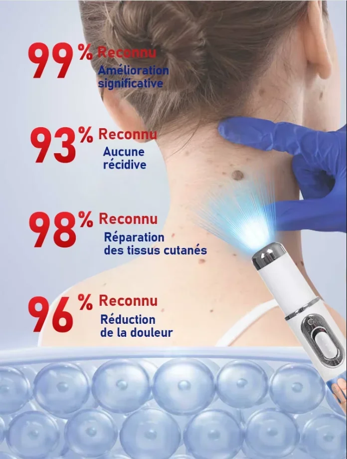 Blue light wart removal tool, more discounts on sets Blue light wart removal tool, more discounts on sets